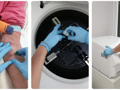 PRP plasma rico en plaquetas Palma